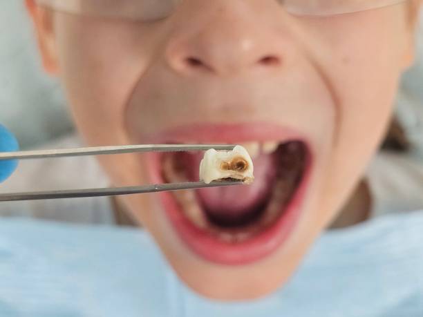 Best Urgent Care for Lost Fillings or Crowns in Line Acres, MO