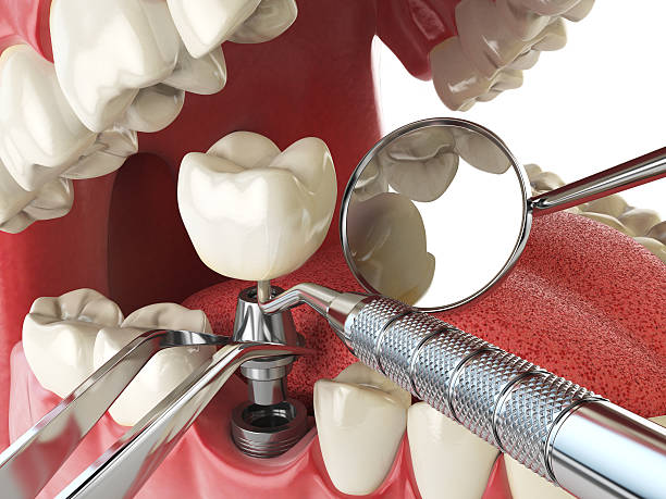 Best Emergency Tooth Extraction in Line Acres, MO